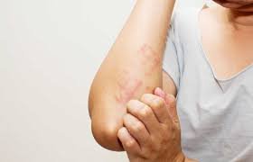 O que é a Dermatite?